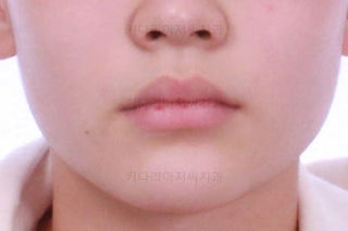 부산연산동치아교정