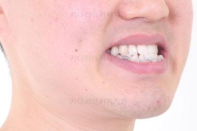 부산비수술교정