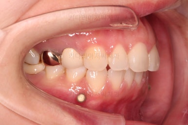 부산부분치아교정