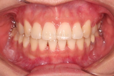 부산사랑니교정