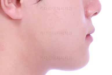 부산주걱턱교정