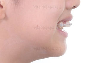 부산토끼치아교정