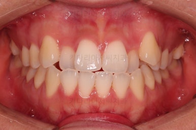 부산비발치교정