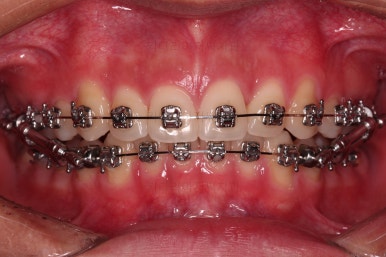 부산연산동치아교정