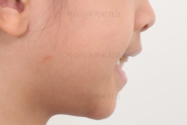 부산어린이반대교합