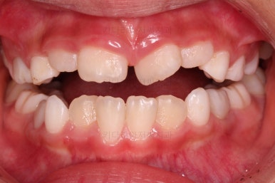 부산어린이반대교합