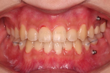 동래구치아교정