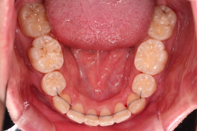 부산돌출입교정