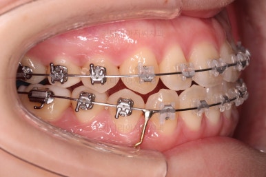 부산치아교정추천