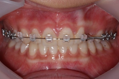 부산매복치아교정