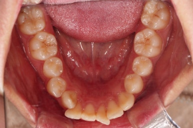 부산클리피씨교정