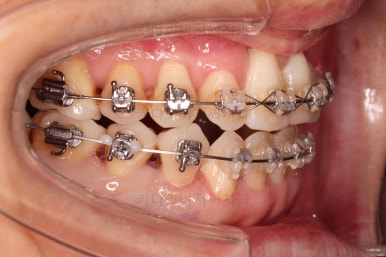 부산구순구개열교정