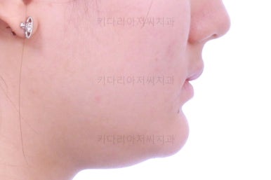 연산동치아교정