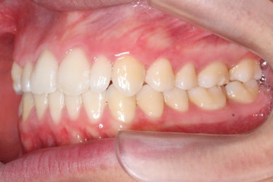 부산왜소치교정