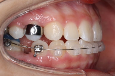 부산치아교정잘하는곳