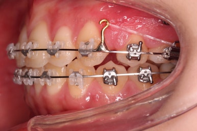 부산돌출입교정