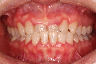 부산치아교정잘하는곳