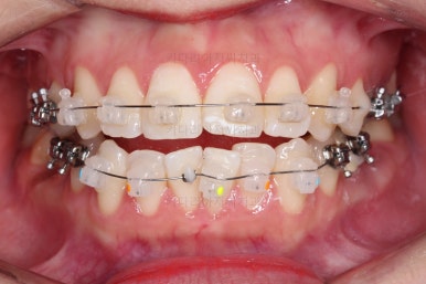 부산사랑니교정