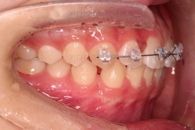 부산앞니벌어짐교정