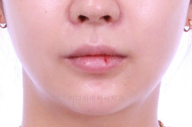 부산안면비대칭