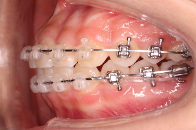 부산치아교정잘하는곳