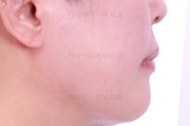 동래임플란트교정