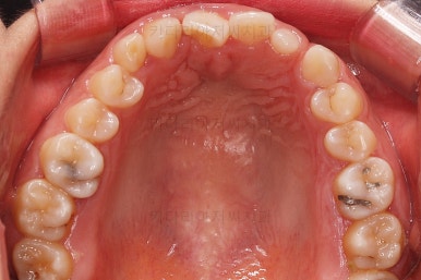 부산구순구개열