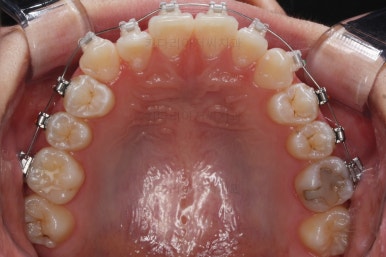 부산치아교정잘하는곳