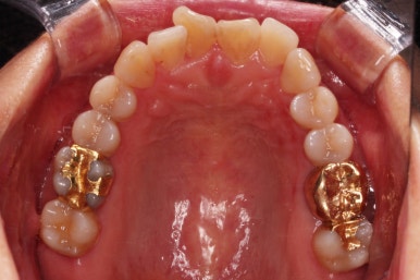 동래임플란트교정