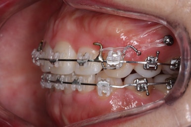 부산연산동교정치과