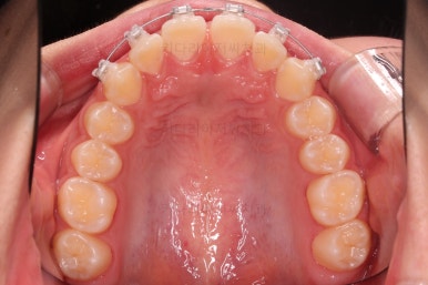 부산앞니벌어짐교정