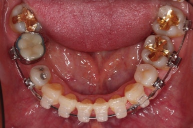 동래임플란트교정