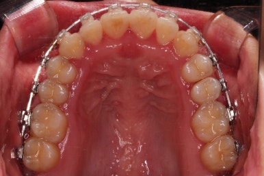 부산비발치교정