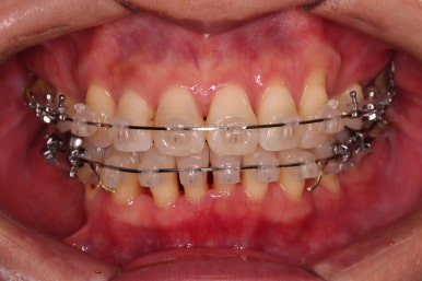 동래임플란트교정