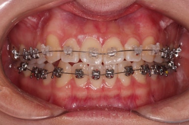 부산치아교정잘하는곳