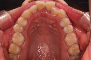 부산비발치교정