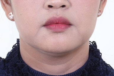 부산사각턱보톡스