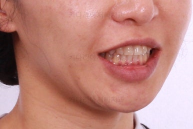 부산연산동교정치과