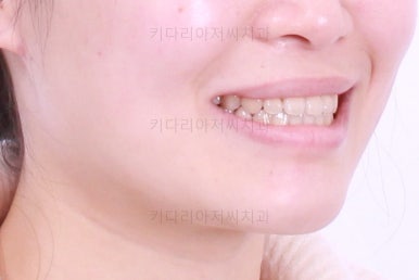 부산치아교정추천