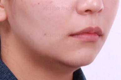 부산사랑니교정