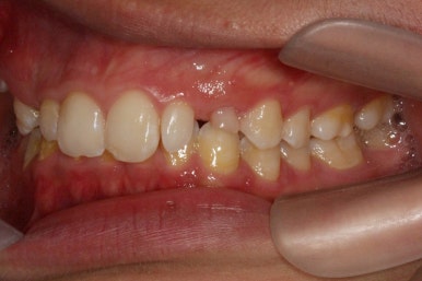 부산왜소치교정