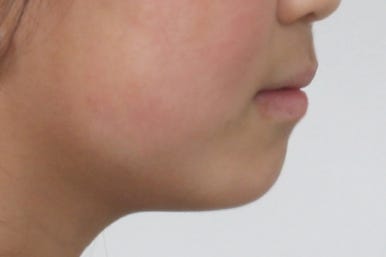 연산동덧니교정