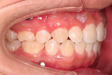 부산청소년치아교정