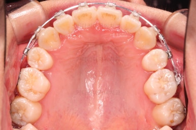 부산치아교정잘하는치과