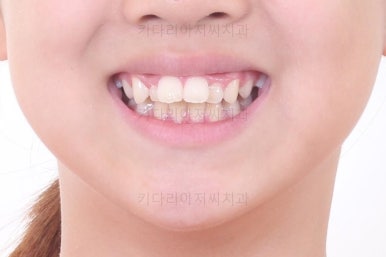 부산토끼치아교정