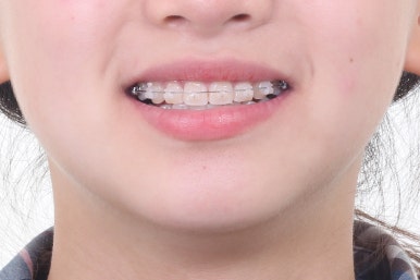 부산치아교정잘하는곳