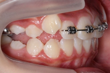 연산동덧니교정