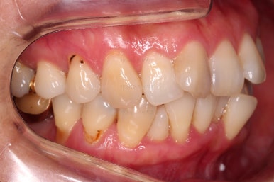 동래임플란트교정
