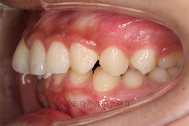 연산동치아교정