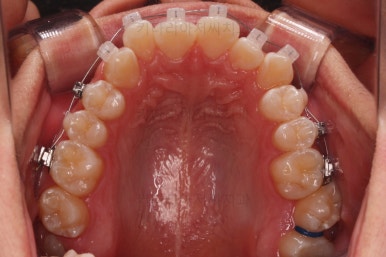 부산청소년치아교정